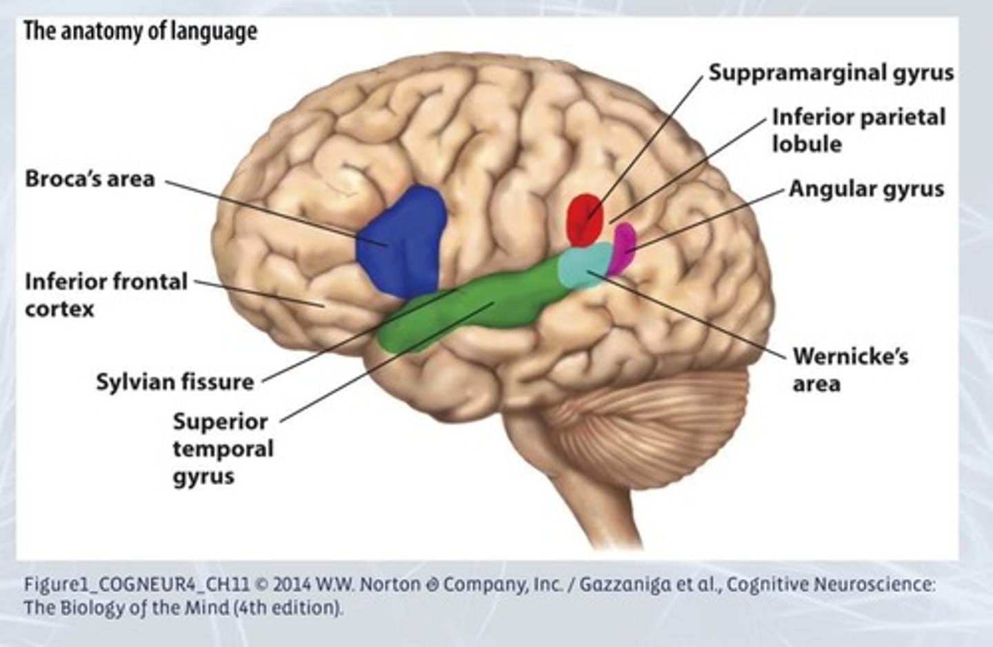 <p>A type of expressive aphasia related to difficulties in producing language and understanding syntactic relationships.</p>