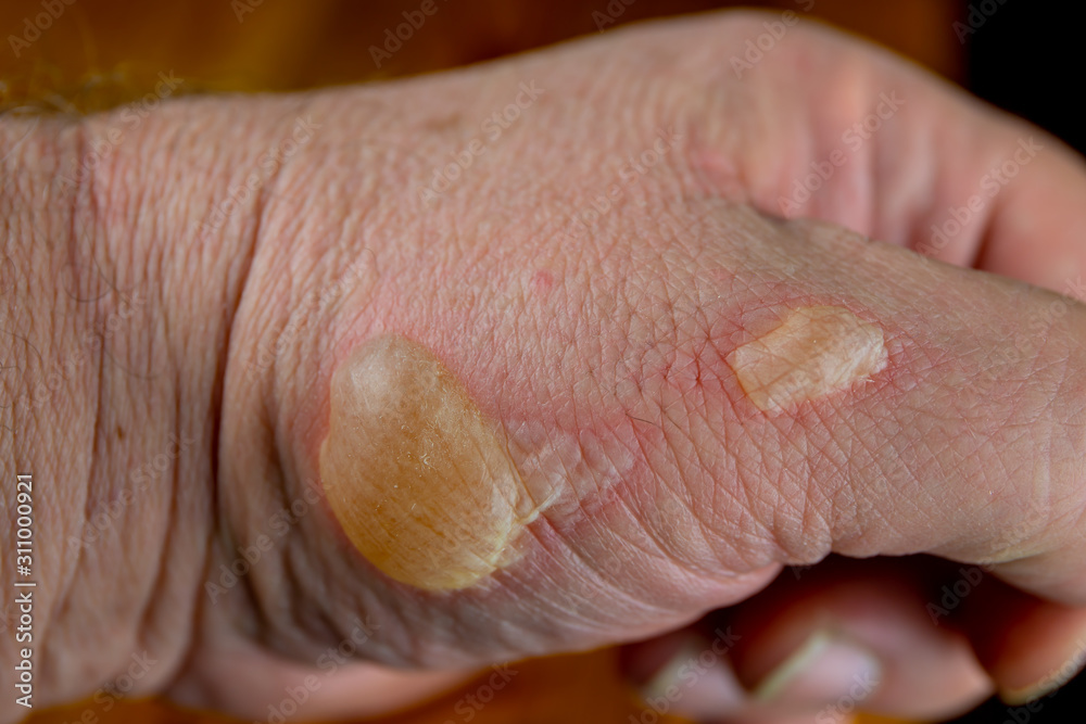 <p>2nd degree burn</p>