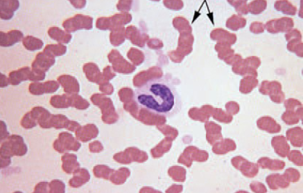 <ul><li><p>stacking of RBC</p></li><li><p>only when found right behind feathered edge</p><ul><li><p>common to see on butt end</p></li></ul></li><li><p>can be seen in normal horses or cat &amp; pigs</p><ul><li><p>sticky RBC’s</p></li></ul></li><li><p>seen w increased fibrinogen &amp; globulin concentrations </p></li></ul><p></p>