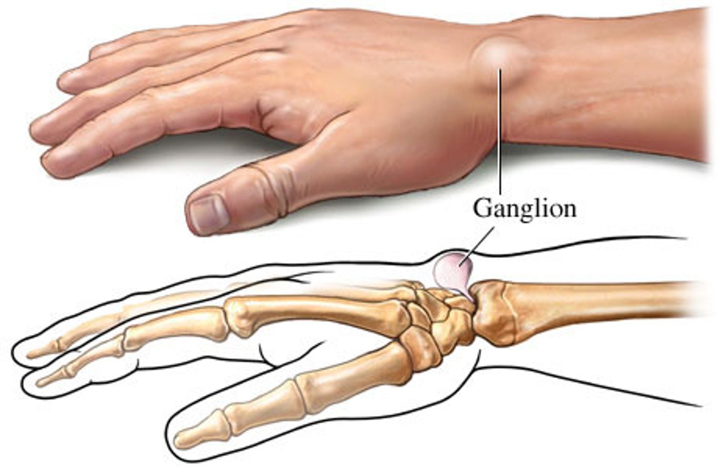 <p>a harmless fluid-filled swelling that occurs most commonly on the outer surface of the wrist</p>