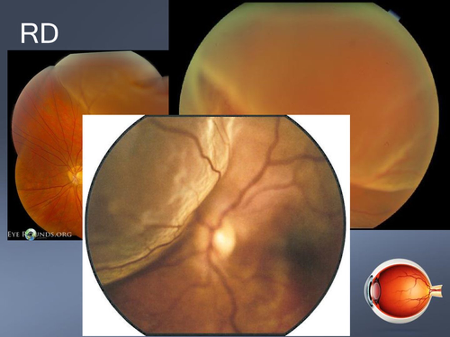 <p>pigment demarcation line</p><p>taut surface of RD</p><p>thinned retina</p><p>intraretinal cysts</p><p>intraretinal exudates</p>
