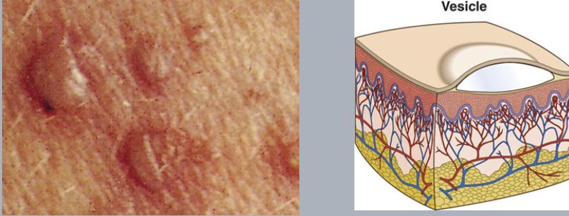 <p>vesicle</p>