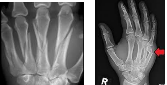 <p>Metacarpal fractures can be described as ____ (proximal), _____ (middle), or ____ (distal)</p>