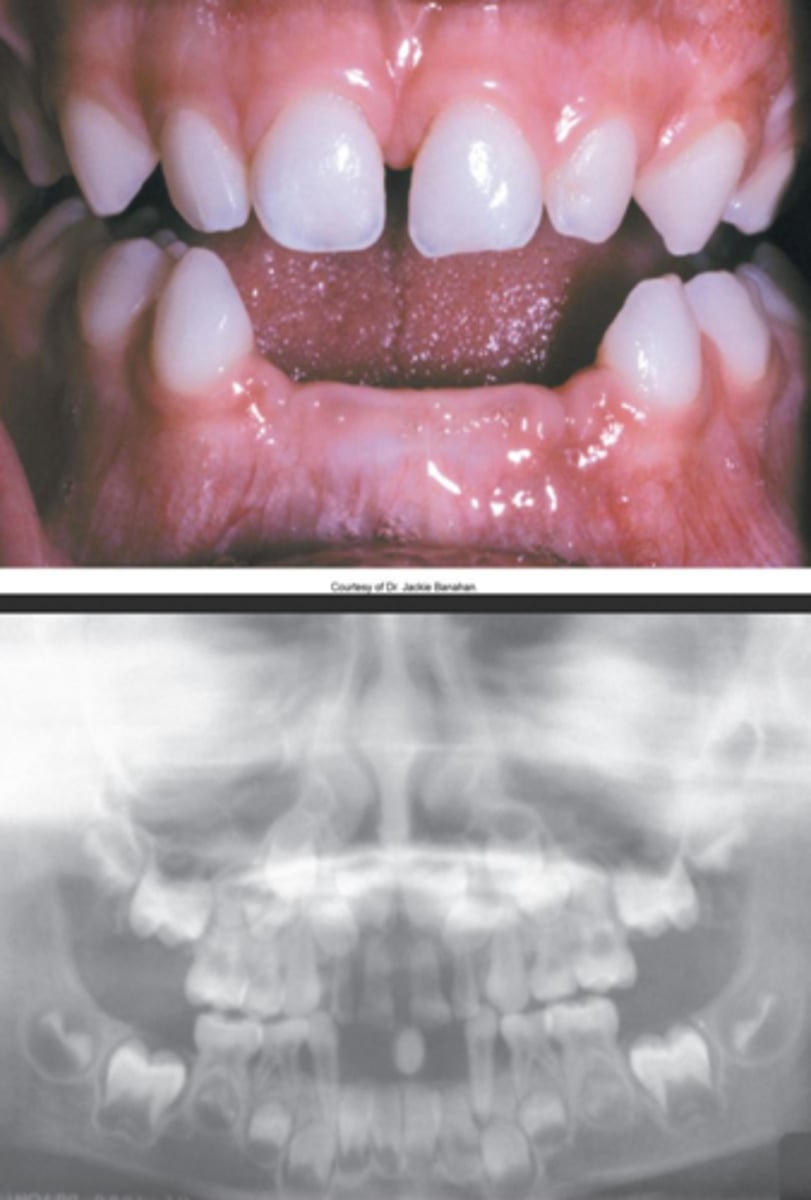 <p>-premature loss of primary teeth</p><p>-enlarged pulp chambers</p>