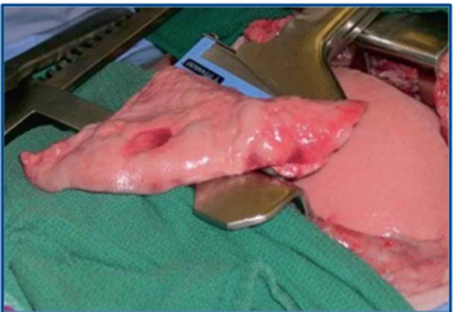 <p>What instrument is being used in this image of a partial pulmonary lobectomy?</p>