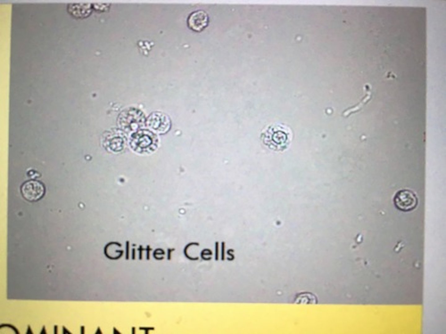 <p>WBC with Brownian movement of granules. Stain faintly or not at all.</p><p>origin: Kidney, bladder, or urethra</p>