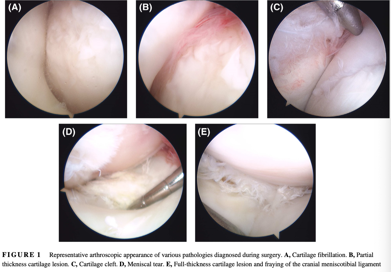 <p>Objective: To report the outcome of horses engaged in Western performance disciplines after stifle arthroscopy and identify prognostic factors for return to performance</p><p>Results:</p><ul><li><p>Most common disciplines represented were cutting (n+38), Western pleasure (n=13), and reining (n=13)</p></li><li><p>Approximately 40% of horses returned to intended use after surgery</p></li><li><p>Increased age, higher degree of lameness, longer duration of lameness, and the presence of partial-thickness cartilage lesions decreased the odds of returning to athletic performance</p></li><li><p>Postoperative therapies (intra-articular: stem cells, corticosteroids, IRAP, HA/polysulfated glycosaminoglycans; systemic: NSAIDs, HA/polysulfated glycosaminoglycans, oral joint supplements) did not affect the odds of returning to intended use</p></li></ul><p>Conclusion: Less than half of the Western performance horses that underwent stifle arthroscopy returned to intended use. Older age, longer duration of lameness, and presence of partial-thickness cartilage lesions affected the odds of a horse returning to intended use. Postoperative therapies did not affect the outcome in this population. The prognosis of Western performance horses undergoing stifle arthroscopy is as guarded as that previously reported in horses of other disciplines</p>