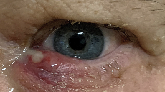<p>Abnormal Finding for<em> </em><strong><em>8. Inspect lacrimal apparatus</em></strong></p><ul><li><p>Indicate infectious or inflammatory condition</p></li></ul><p></p>