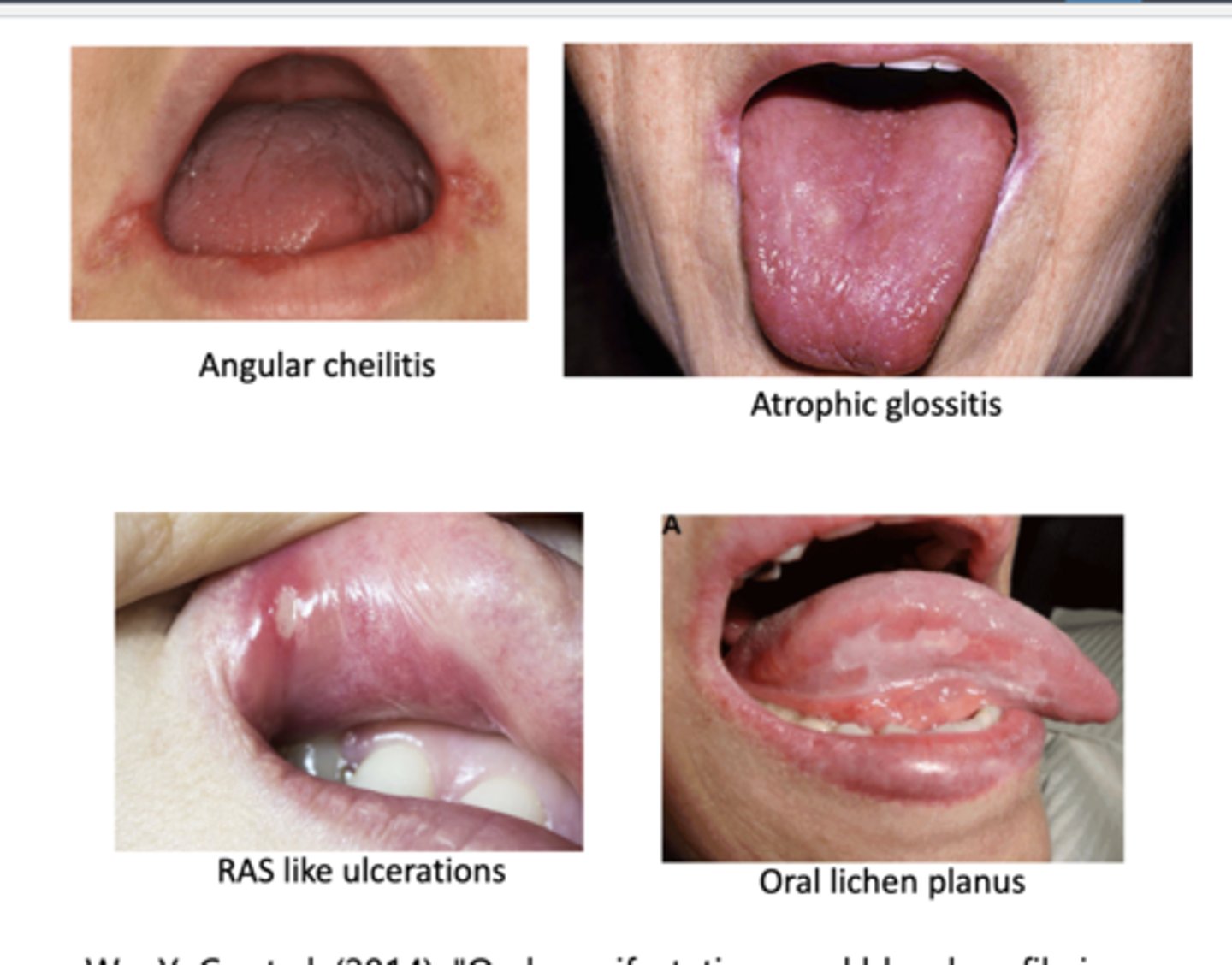 <p>-angular cheilitis</p><p>-atrophic glossitis</p><p>-RAS like ulcerations</p><p>-oral lichen planus</p><p>-xerostomia</p><p>-numbness</p><p>-burning sensation</p><p>-dysgeusia--&gt; altered taste perception</p>