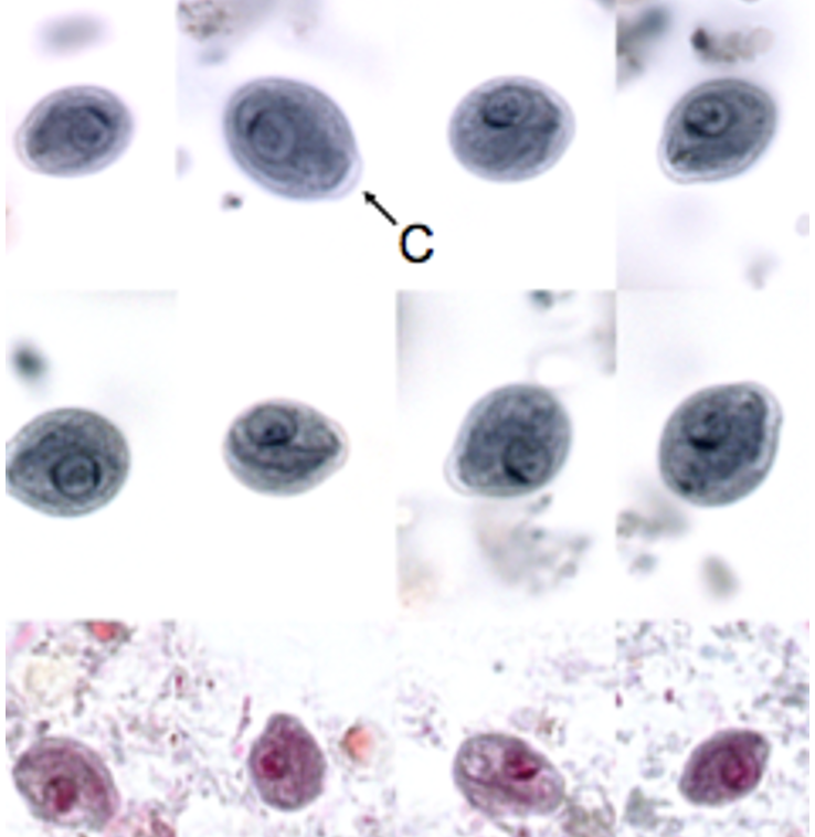 <p><span>Chilomastix mesnili</span><br><span>Stage: cyst</span></p><p><span>( </span>Lemon-shaped, single nucleus<span> )</span></p>