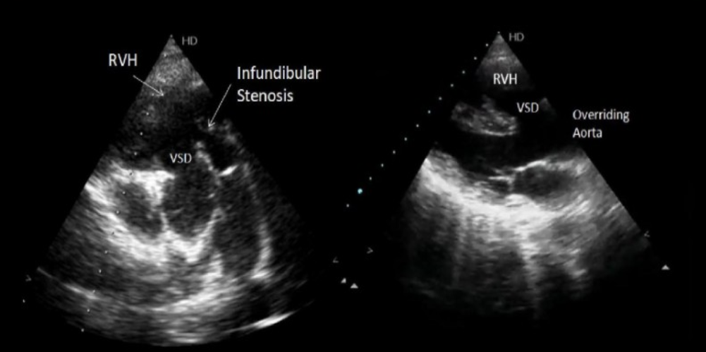 <ol><li><p>VSD</p></li><li><p>Overriding aorta </p></li><li><p>Infundibular stenosis </p></li><li><p>RVH</p></li></ol><p></p>
