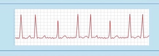 <p>no P wave = fib is floPPing</p>