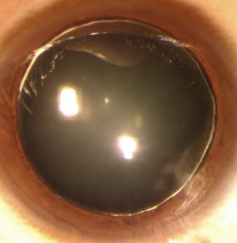 <p>One of the 4 Lens Abnormalities</p><ul><li><p>Rare congenital lens abnormality where the lens is <strong>abnormally small and spherical</strong>, leading to refractive errors susch as myopia or lens dislocation</p></li></ul><p></p>