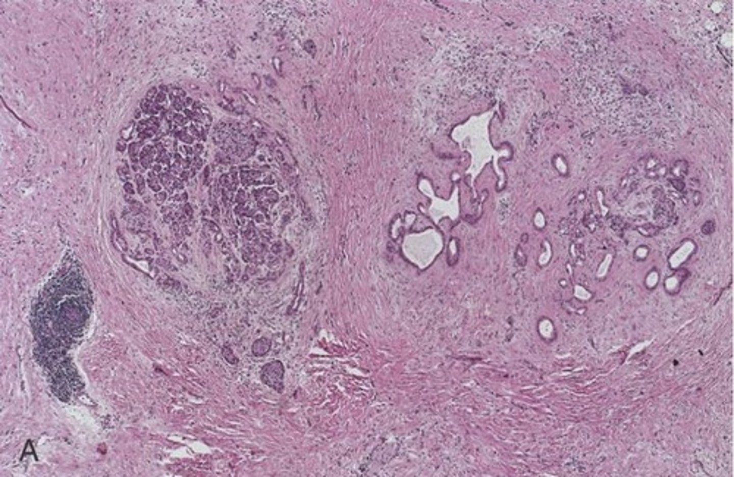 <p>Chronic pancreatitis may destroy acinar cells, then islets, leading to:</p>