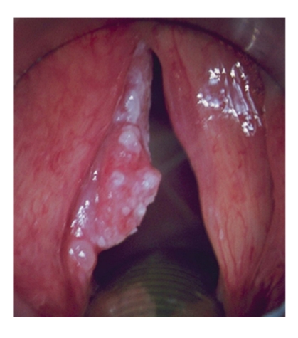 <p>Meestal vroegtijdig symptomen: heesheid. <br>Stridor bij grotere tumoren<br>T1 ware stembanden<br>T2 uitbreiding naar supra/subglottis, vertraagde <br>mobiliteit<br>T3: gefixeerde stemband (ingroei in <br>spier/gewricht)<br>T4: doorgroei doorheen kraakbeen van larynx<br>T1/T2: radiotherapie of chordectomie of <br>Klik om het opmaakprofiel van de modelondertitel te bewerken<br>partiële laryngectomie<br>T3: radiochemotherapie of partiële/totale <br>laryngectomie<br>T4: totale laryngectomie</p><p>(bij T3 of T4 bestralin want is beter voor de stem)</p>