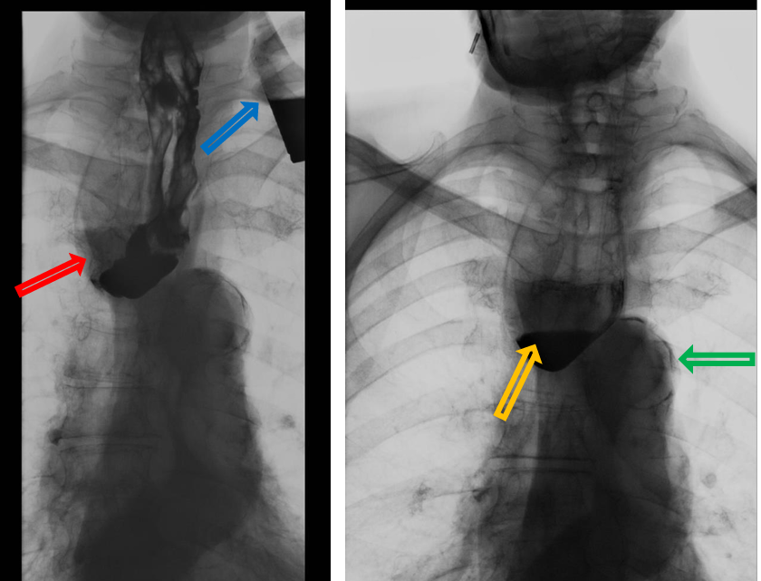 <p>Patient history: dysphagia and sensation of food stuck </p><p>Modality: barium swallow test, fluoroscopy </p><p>Region: esophagus Radiologic sign: outpouching (red arrow) filled with contrast material near the pharyngo-esophageal junction; air-fluid level (yellow arrow) in the outpouching; dilated, sclerotic aorta (green arrow); glass filled with contrast material (blue arrow) </p><p>Diagnosis: Zenker’s diverticulum, aortosclerosis</p>