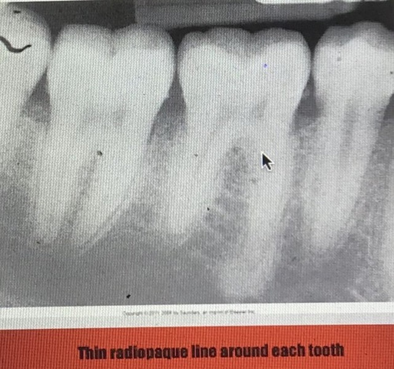 <p>Alveolar bone proper/ cribiform plate/ lamina dura (radiographic name): type of bone that lines the sockets where roots sit</p><p>- thin and compact</p><p>- small openings for vascularity</p><p>2 layers</p><p>- compact lamellar bone</p><p>- layer of bundle bone into which the periodontal fibers insert</p><p>* core of the fibers remain uncalcified in the calcified tissues of bone or cementum (sharpey’s fibers)</p>