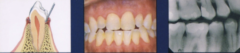 <ul><li><p>Inflammation of the gingiva</p></li><li><p>Clinically: change in color, gingival form, position, surface appearance, presence of bleeding/exudate</p></li></ul><p></p>