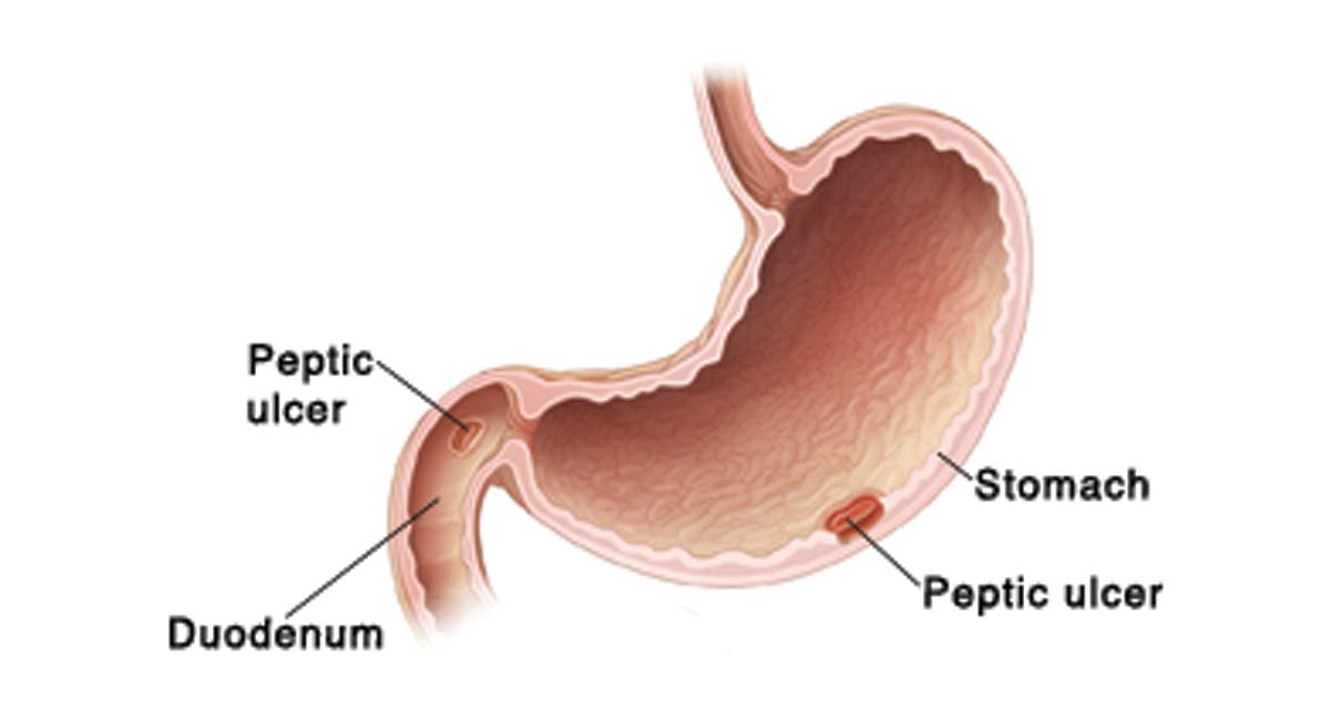 <p>Peptic ulcer</p>