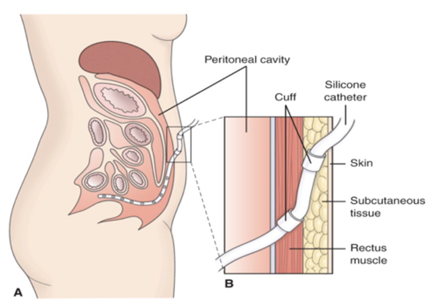 <p>the lining of the peritoneal cavity acts as the filter to remove waste from the blood</p><p>used when ESKD is <10% GFR</p><p>high risk of sepsis and peritonitis</p>