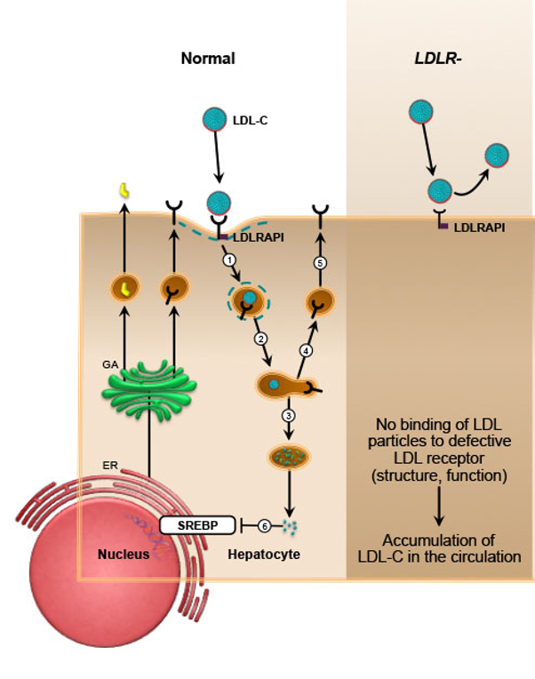 <p><span>•LDL receptor mutations (&gt;1000)</span></p><p><span>•receptors are missing or nonfunctional</span></p><p><span>•cholesterol accumulates in the blood stream and predisposes the person to atherosclerosis and heart attack</span></p><p><span>•blood cholesterol level 1000 mg/dL(</span></p><p><span>•normal &lt; 200mg/dL )</span></p><p>ormal Pathway</p><p></p><p>On the left, the diagram shows the healthy, functional process:</p><ol><li><p>LDL receptors are produced inside the cell and placed on the cell surface.</p></li><li><p>These receptors recognize and bind to LDL cholesterol (LDL-C) particles circulating in the blood.</p></li><li><p>The receptor-LDL complex is then taken into the cell (endocytosis), effectively clearing cholesterol from the bloodstream.</p></li></ol><p></p><p>Defective Pathway (LDLR-)</p><p></p><p>The panel on the right illustrates what happens when there is a mutation in the LDL receptor gene (LDLR-).</p><ul><li><p><strong>The Defect:</strong> The cell produces LDL receptors that are structurally or functionally defective. As the text states, there is</p><p><strong>"No binding of LDL particles to [the] defective LDL receptor"</strong>.</p><p></p></li><li><p><strong>The Consequence:</strong> Because the liver cells cannot grab onto and remove LDL from the blood, the cholesterol is left to <strong>accumulate in the circulation</strong>. This leads to dangerously high blood cholesterol levels and a significantly increased risk of atherosclerosis and heart attacks.</p></li></ul><p></p>
