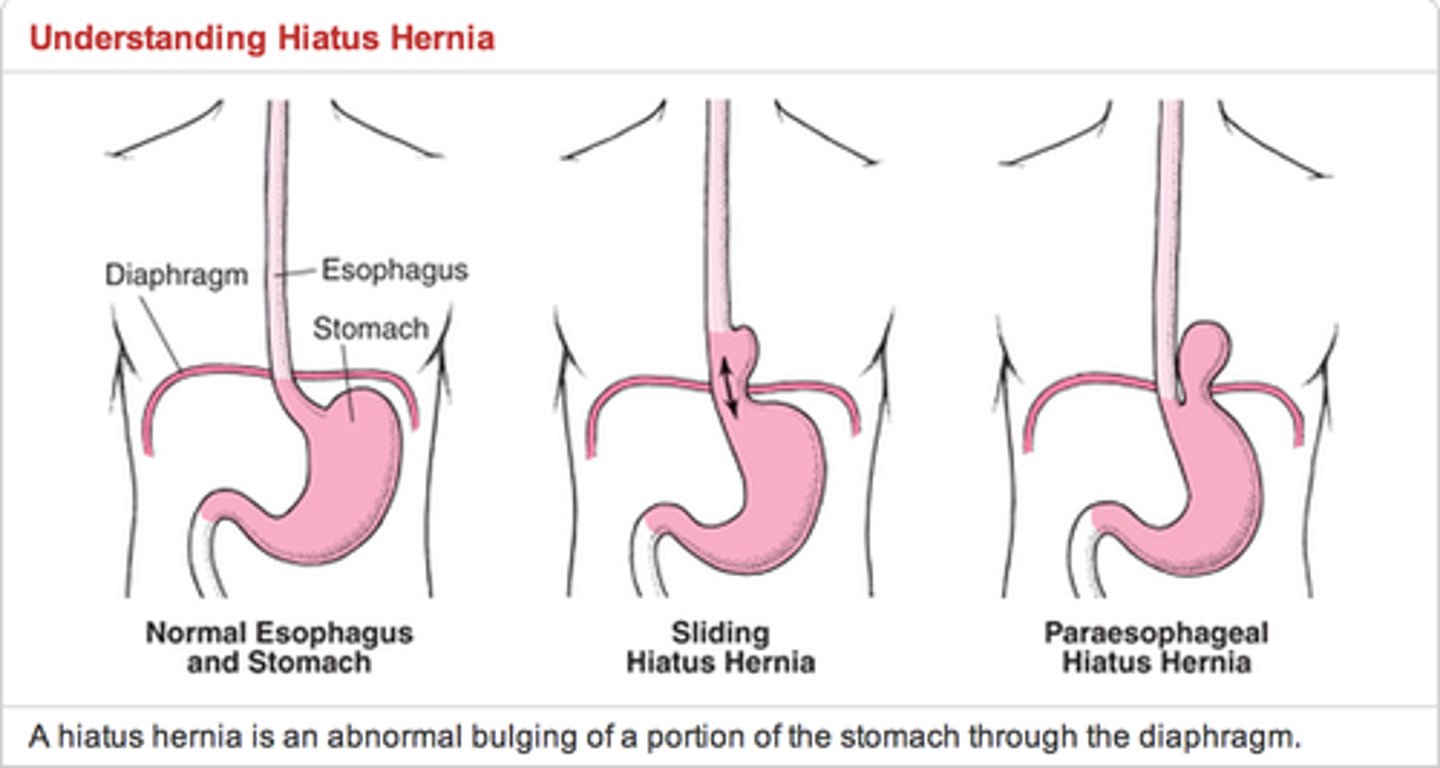 <p>Both the stomach and GE junction herniate into the thorax via the esophageal hiatus; also known as type I hiatal hernia</p>