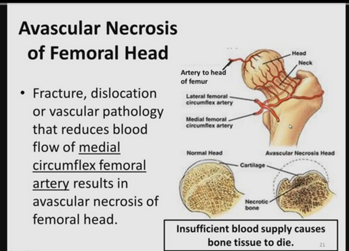 <p>An intracapsular fracture of the hip can lead to a condition known as avascular necrosis - this is because an intracapsular fracture may cut off the blood supply to the head of the femur </p>