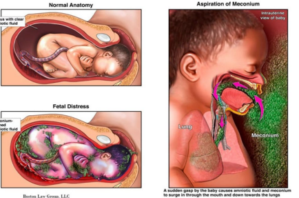<p><strong>Meconium Aspiration Syndrome: Patho and Signs/Symptoms </strong></p><p>-Patho → __________ in utero by distressed, gasping fetus or immediately _____ delivery </p><ul><li><p>Leads to small airway __________, air trapping, surfactant inactivation, alveolar air ______, atelectasis, or chemical ____________</p></li></ul><p>-Signs/Symptoms → tachypnea, _________, hypercapnia, overdistention of the chest </p><p></p>