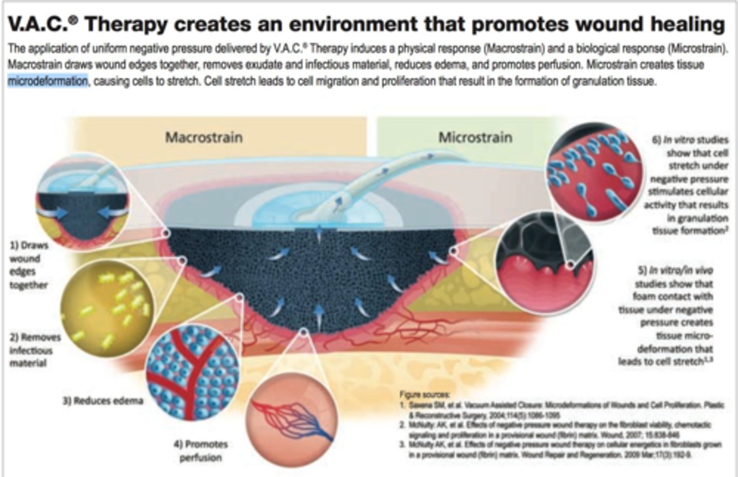 <p>When you can visually see the tissues within a wound vac getting pulled together</p>