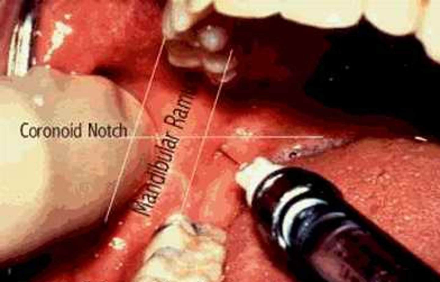 <p>(1) Errors in evaluation and planning</p><p>(2) Local anesthetic injection</p><p>(3) Bone drilling</p><p>(4) Implant placement</p>