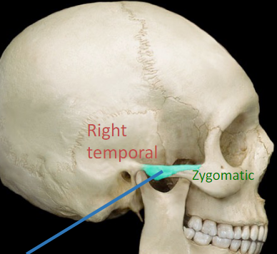 <p>part of zygomatic arc that makes up the &quot;cheek&quot; (side of cheekbones)</p>