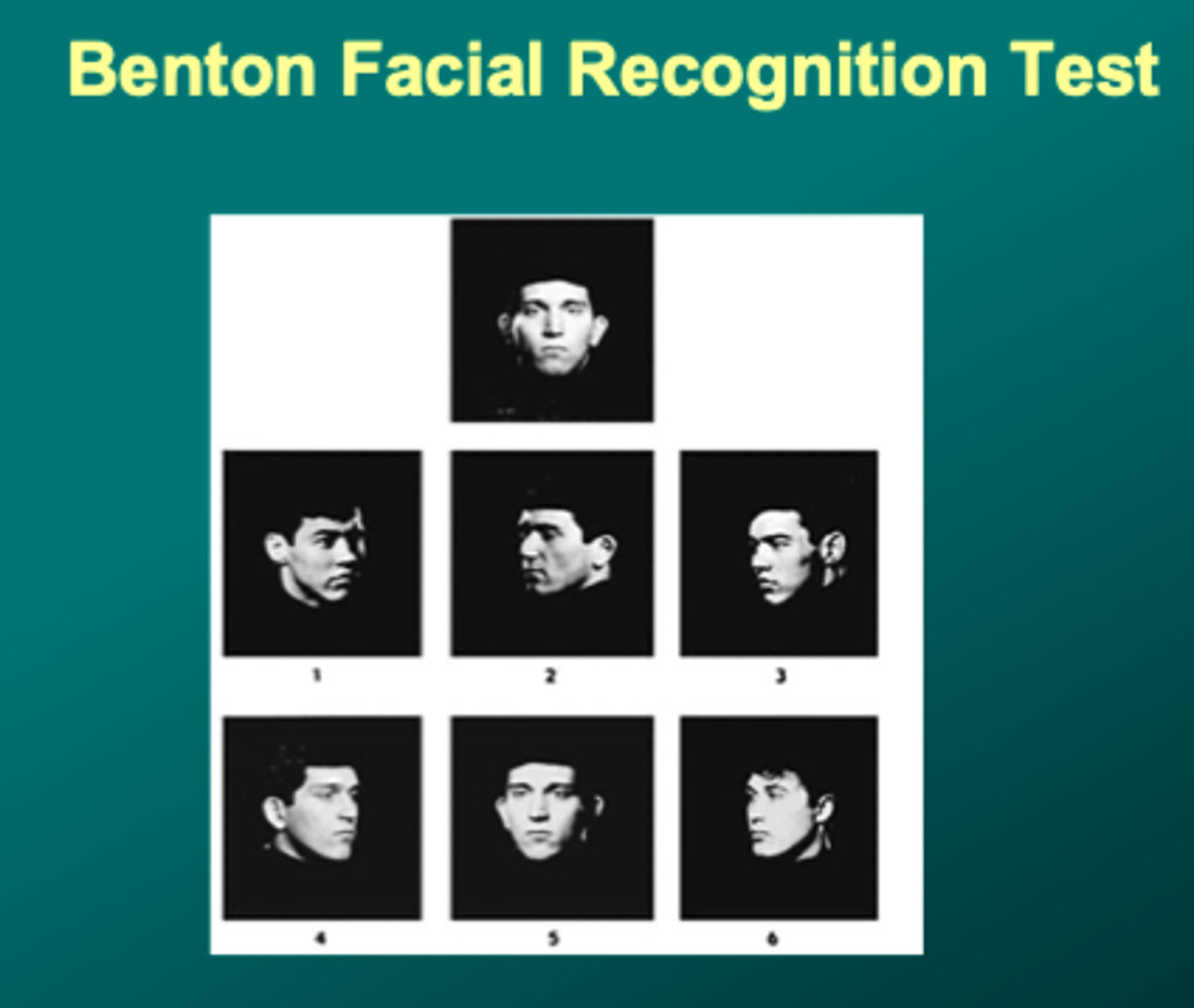 <p>impaired perception of facial expression, impair on benton facial recognition test</p><p>reported images of family members had distorted facial proportions but she could not tell which way</p><p>SCR arousal was higher for families</p>
