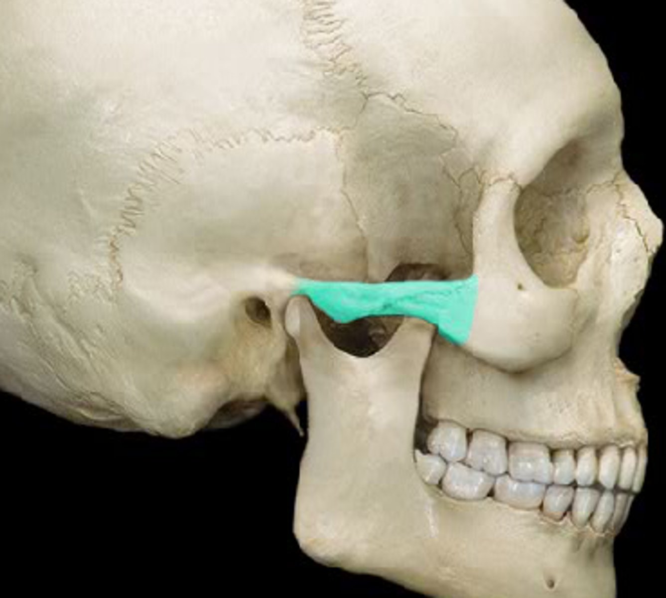 <p>Process' of both Zyg & Temp bone</p>