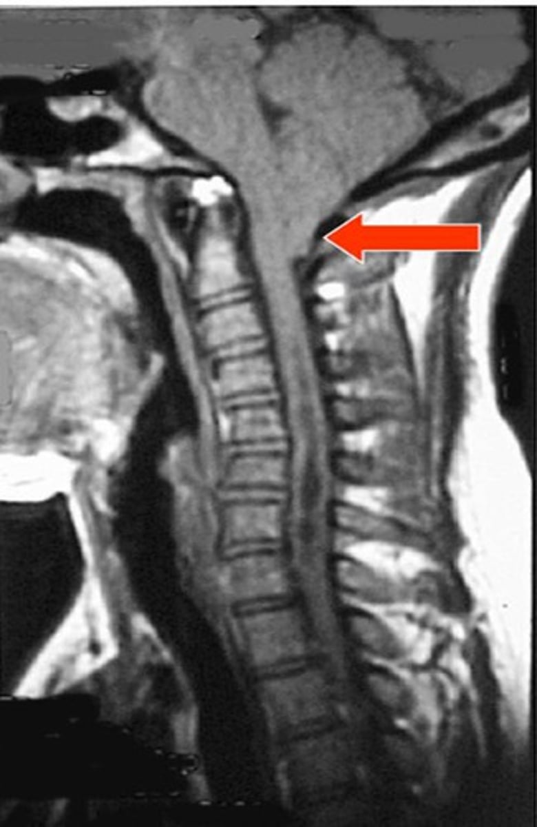<p>Define Brain Herniation:</p><p>Leads to...</p><p>-Brainstem Compression ==&gt; Respiratory &amp; Cardiac compromise ==&gt; DEATH!</p>