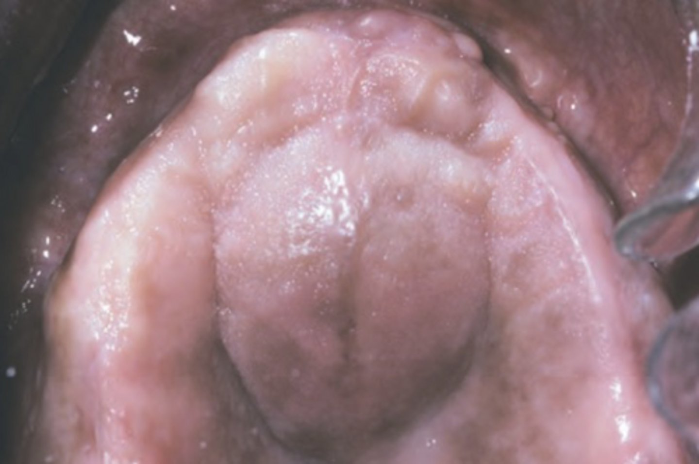 <p>nasopalatine duct cyst</p>