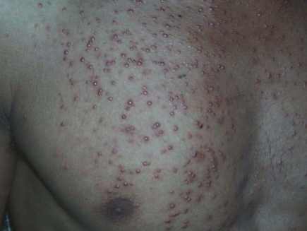 <p>what type of lesion and condition is depicted</p>