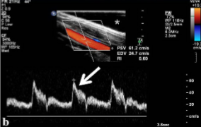 <p>What doppler angle should be used for duplex imaging?&nbsp;</p>