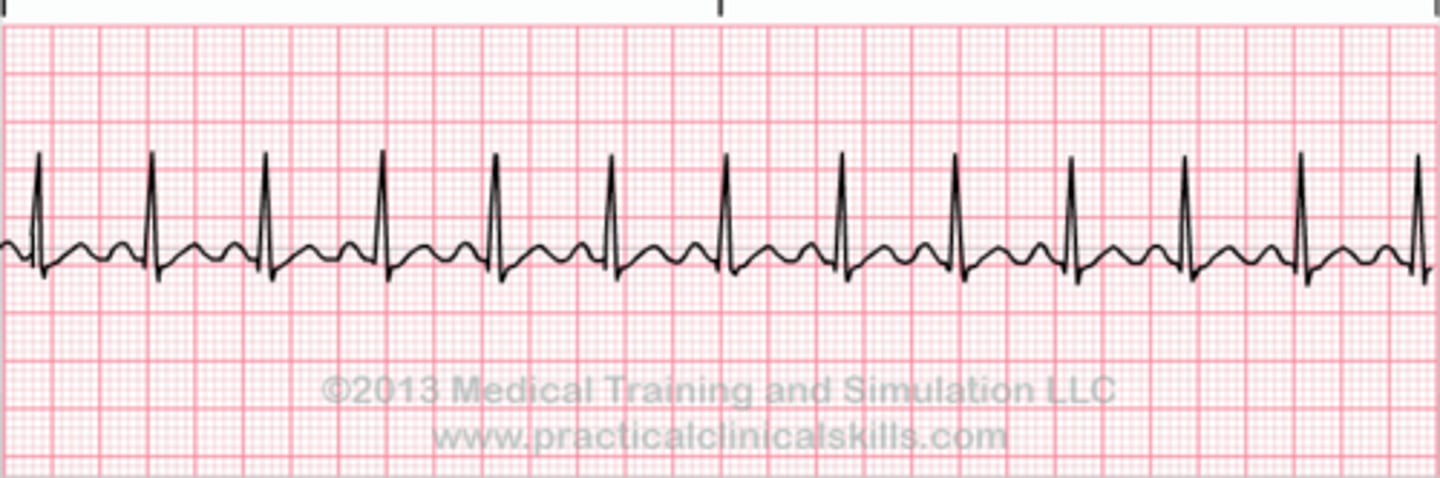 <p>- heart attempting to meet increased need fo oxygen to tissues</p><p>- HR: &gt; 100</p><p>- P-wave: normal</p><p>- PR interval: normal</p><p>- QRS: normal</p><p>- R-R: regular</p><p>- unstable pt: altered LOC, ischemia, shock or decreased BP --&gt; synchronized cardioversion</p>