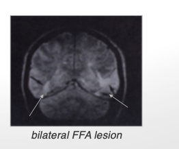 <ul><li><p>unable to recognize familiar faces (even one’s own)</p></li><li><p>able to recognize ppl using other features (voice, hair)</p></li><li><p>bilateral damage to fusiform face area (FFA)</p></li></ul><p></p>