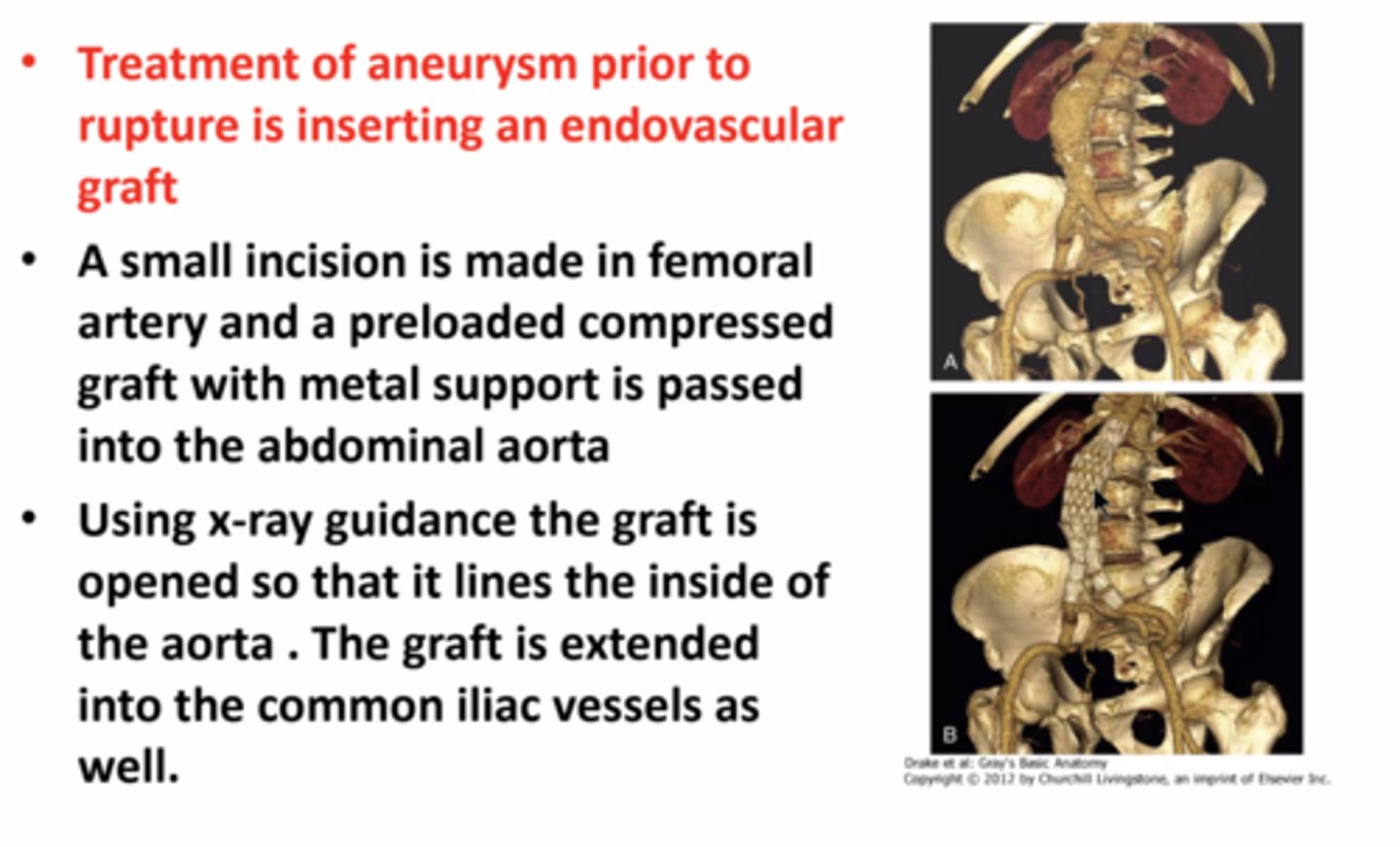 <p>• an abdominal aortic aneurysm is a dilatation of the aorta and generally occurs in the infrarenal region (the region at or below the renal arteries) </p><p>treatment prior to rupture of the aorta -</p><p>• surgically dissecting the femoral artery below the inguinal ligament; preloaded compressed graft with metal support is passed on a large catheter in the abdominal aorta using the femoral artery. it is fitted inside the aorta and then attachments are made to the graft that extends into the common iliac vessels. </p>