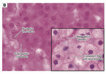 <p>Light microscopic appearance of steroid hormone-secreting cells. H&amp;E, x800 main panel and inset</p><p>Light microscopic views of steroid hormone-synthesizing cells reveal only a hint of the distinctive set of structures that characterize the cytoplasm of these cells. The eosinophilia (acidophilia) of the cytoplasm is largely attributable to the abundance of mitochondria. Steroid hormone-secreting cells vary in the amount of cholesterol stored in the form of lipid droplets, which appear in most preparations as empty vacuoles because their contents are extracted during specimen preparation. The cells in the main panel are in the zona reticularis and have few droplets, similar to the cell in the electron micrograph (Fig. 2-10A). The cells in the inset are from the zona fasciculata and have numerous lipid droplets.</p>