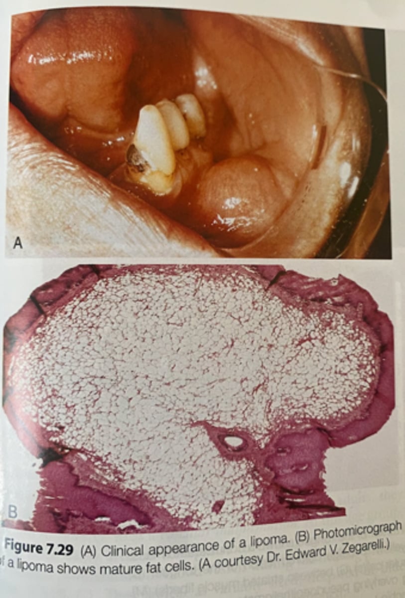 <p>-benign tumor of adipose tissue</p><p>-clinically appears as a yellowish mass that is surfaced by a thin layer of epithelium</p><p>-mature fat cells</p>