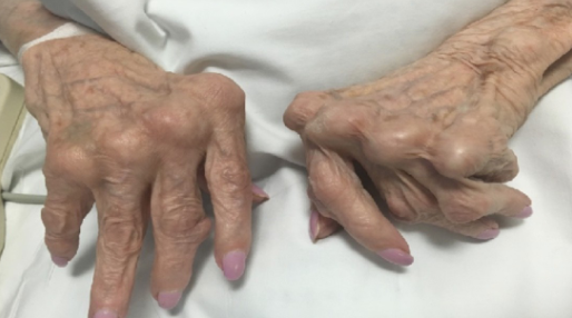 <p>Rheumatoid Arthritis</p>