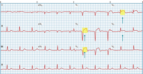 <p>ST-Elevation MI (STEMI)</p><p>Caused by- ________________</p><p>Myocardial cell death occurs</p><p>ST segment elevation</p>
