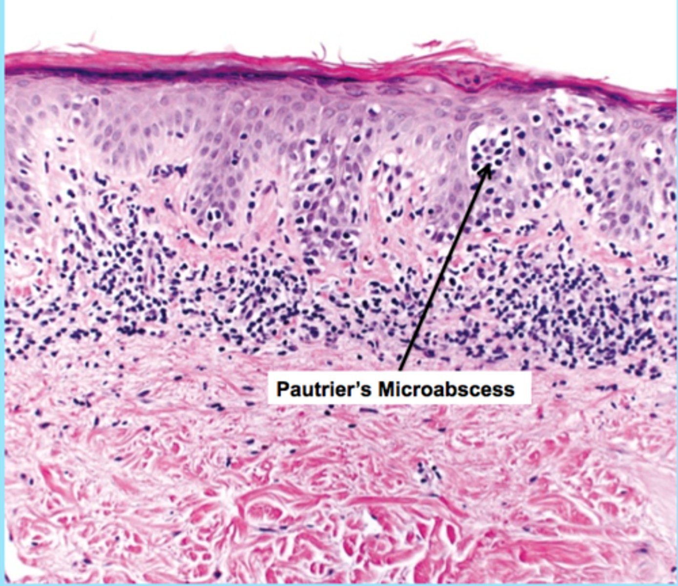 <p>MYCOSIS FUNGOIDES</p>