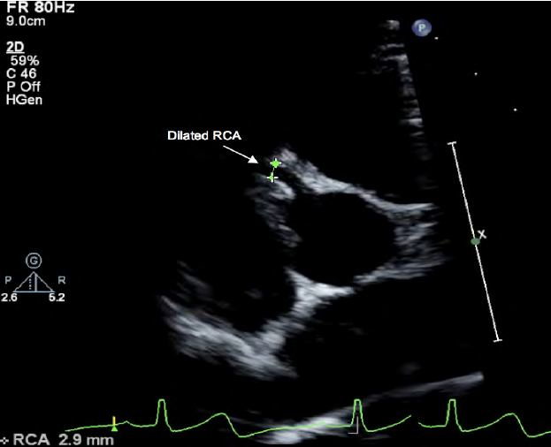 <p>What artery is seen in this image?</p>