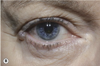 <p>As a round translucent cyst on the anterior lid margin. It is not painful and the treatment is observation. </p>