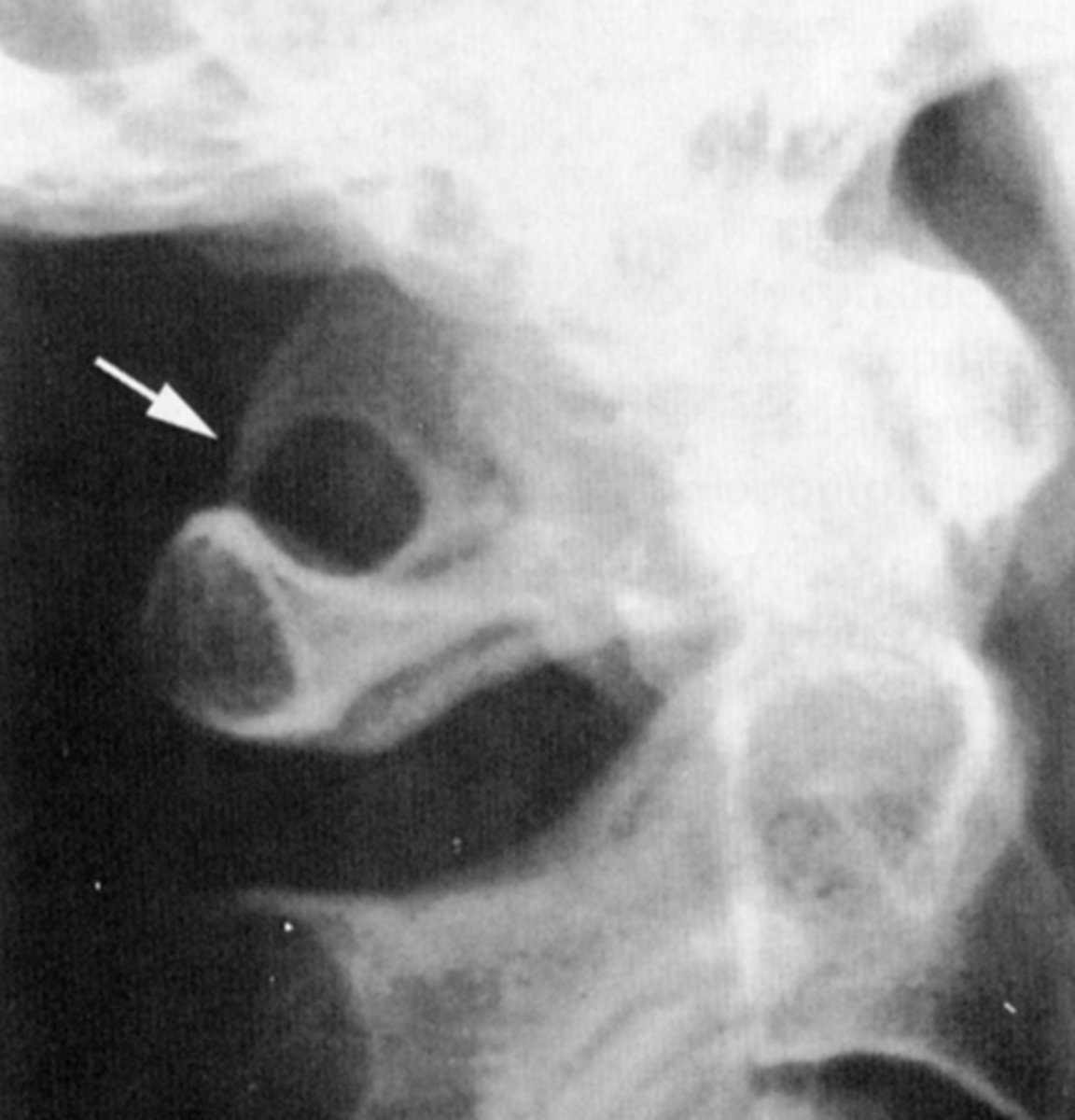 <p>The hole that is formed by the ossification that the vertebral artery must pass through</p>