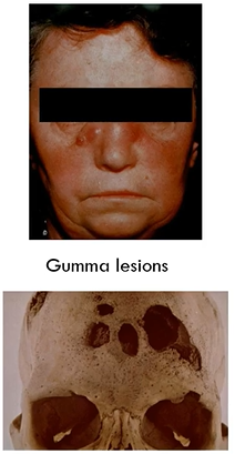 <ul><li><p>due to infection with Treponema pallidum</p></li><li><p>occurs in tertiary syphilis</p></li><li><p>especially in cardiovascular system and central nervous system</p></li><li><p>causes gumma lesions</p></li><li><p>variation of coagulative necrosis</p></li></ul><p></p>
