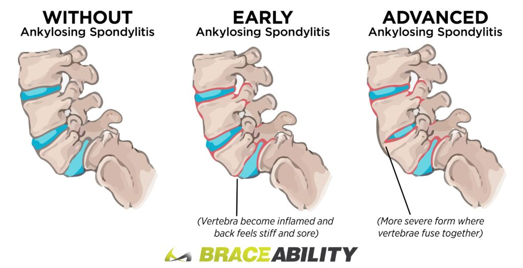 <ol><li><p>pain to neck and back</p></li><li><p>stiffness</p></li><li><p>limited ROM</p></li><li><p>numb/ting/weakness in arms or legs</p></li></ol><p></p><ol><li><p>hyperextension of neck, back </p></li><li><p>lateral neck flexion </p></li><li><p>prolonged sitting</p></li></ol><p></p>